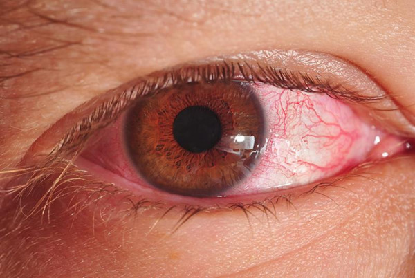 ما هي اسباب احمرار العين الوردية وطرق العلاج