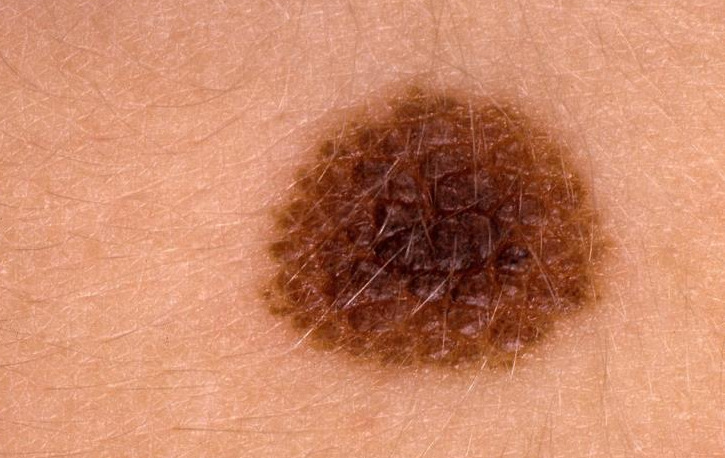 الميلانوما.. أخطر أشكال سرطان الجلد