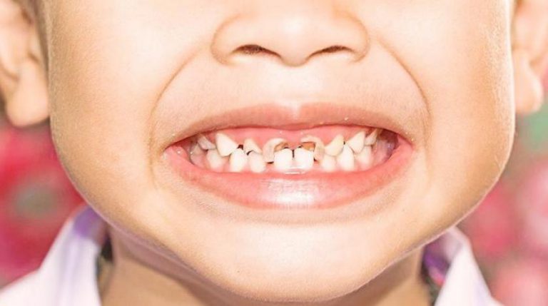 تسوس الاسنان عند الطفال